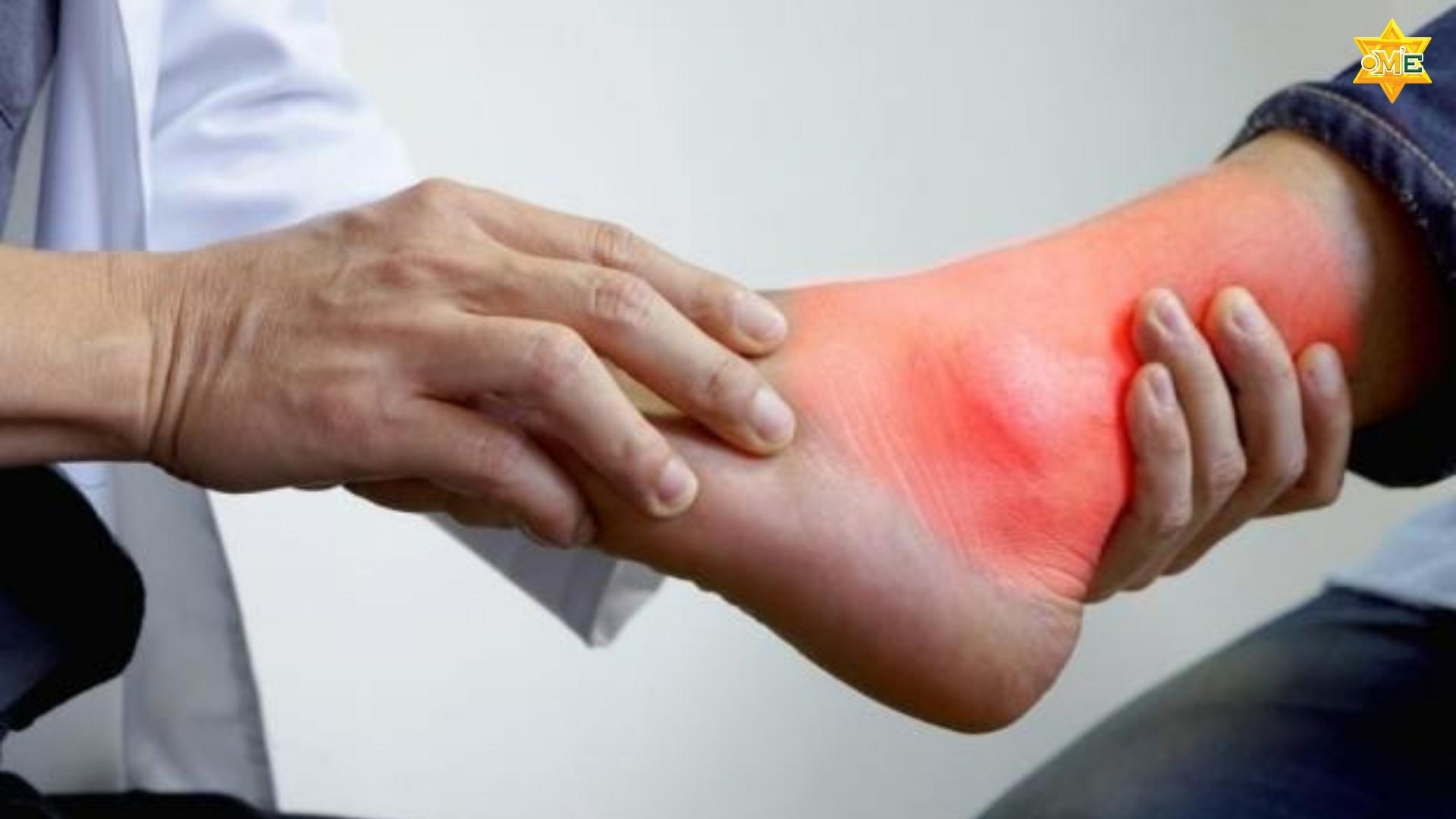 Hướng Dẫn Xoa Bóp Chữa Bệnh Gout
